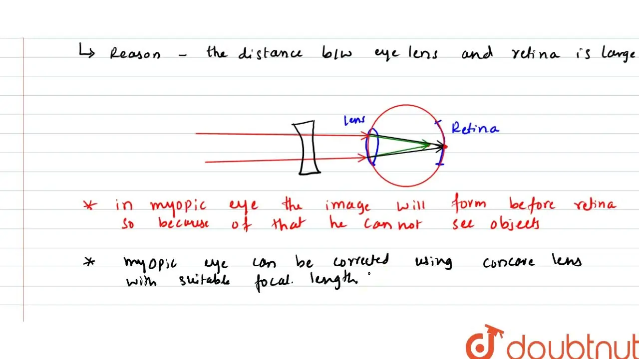 [Kannada] What is short sight? How can it be corrected?